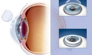 2021年icl晶体植入医保报销 icl人工晶体植入手术